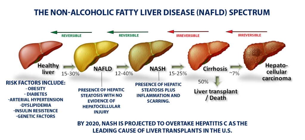 Fatty Liver Disease Texas Liver Institute