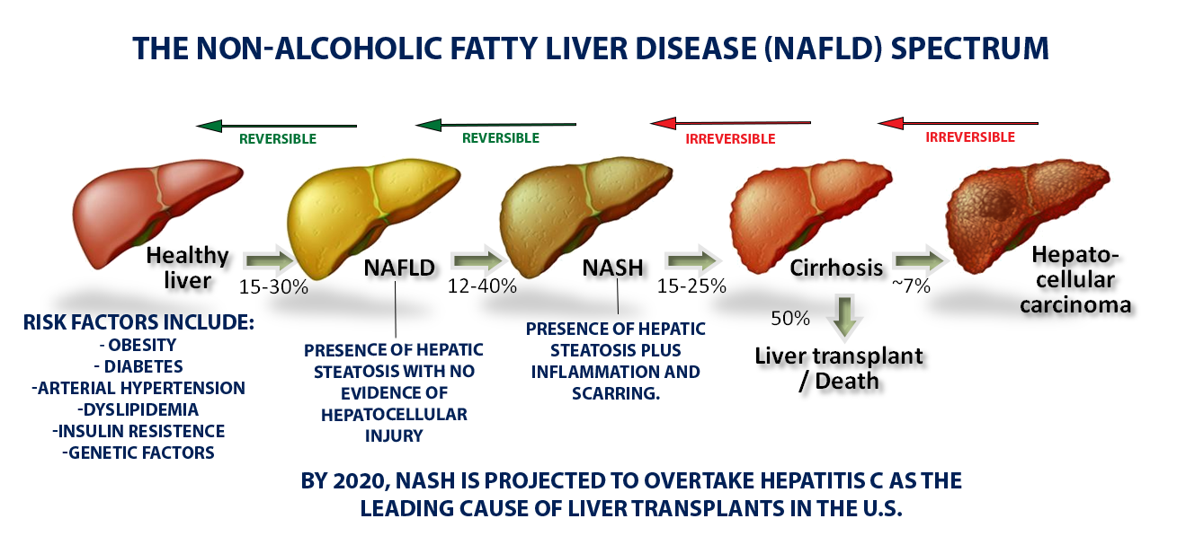 Fatty Liver Disease - Texas Liver Institute