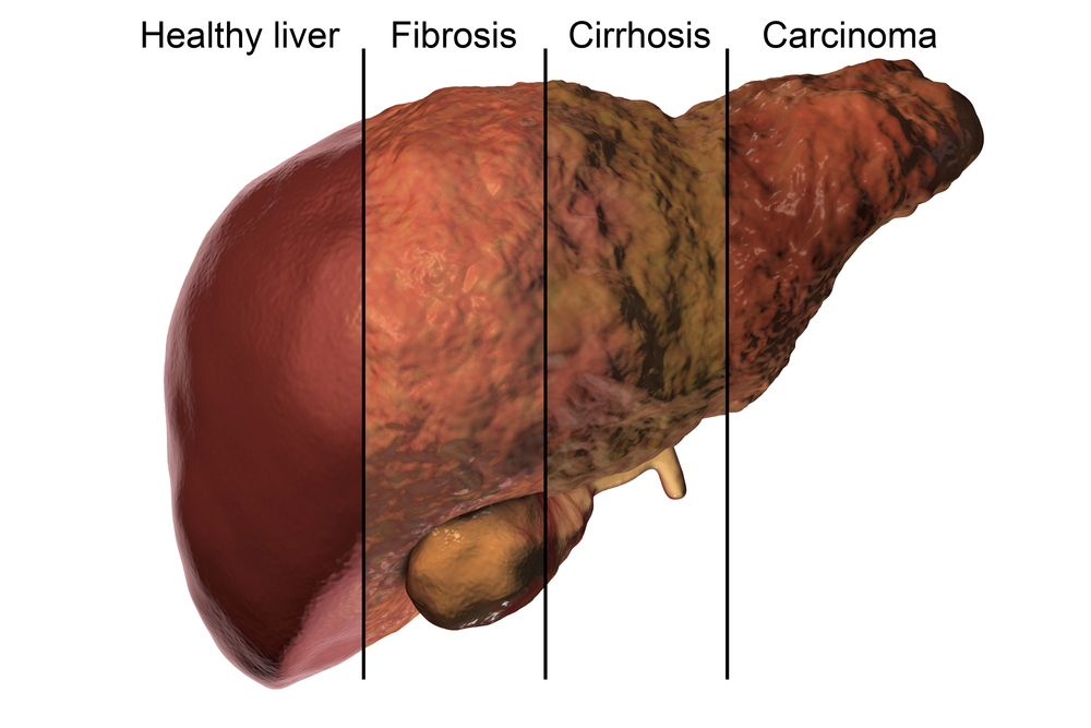 How To Repair A Liver Damaged By Alcohol