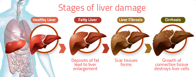 Management of Nonalcoholic Fatty Liver Disease: Lessons Learned